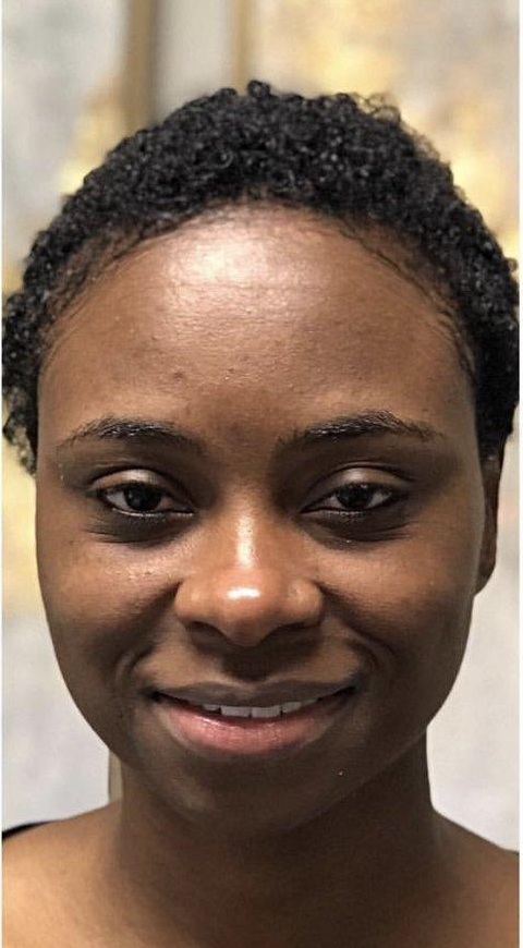 Hydrafacial Deluxe - Brighter, smoother and deeply hydrated skin after a professional Hydrafacial treatment. — before