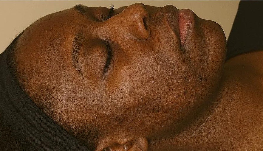 Microneedling - Reduction in acne scars with improved skin texture and collagen production. — before