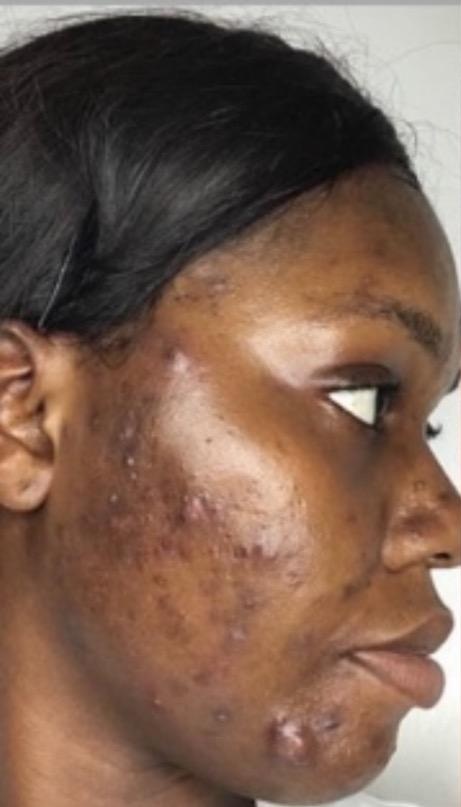 Acne Treatment - Clearer skin with reduced active acne and healthier complexion after treatment. — before
