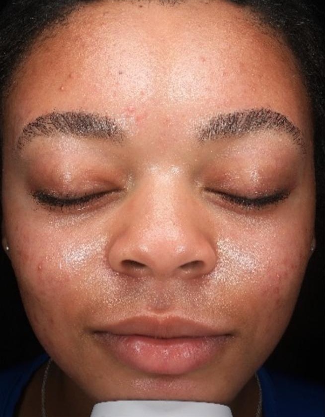 Hydrafacial Deluxe - Brighter, smoother and deeply hydrated skin after a professional Hydrafacial treatment. — before