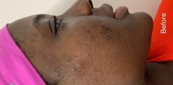Acne Treatment - Clearer skin with reduced active acne and healthier complexion after treatment. — before