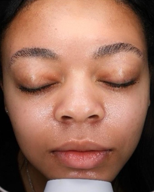 Hydrafacial Deluxe - Brighter, smoother and deeply hydrated skin after a professional Hydrafacial treatment.