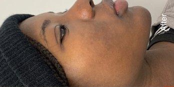 Acne Treatment - Clearer skin with reduced active acne and healthier complexion after treatment.