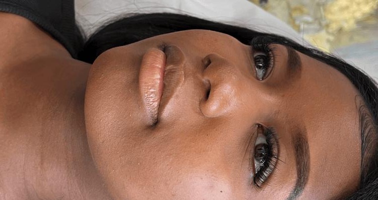 Lip Enhancement - Natural-looking lip enhancement with improved symmetry and definition. — before