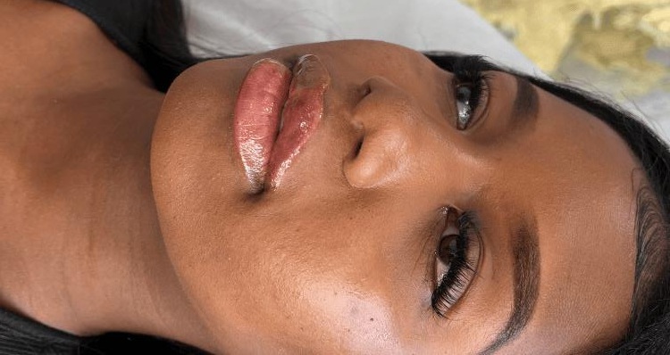 Lip Enhancement - Natural-looking lip enhancement with improved symmetry and definition. — after