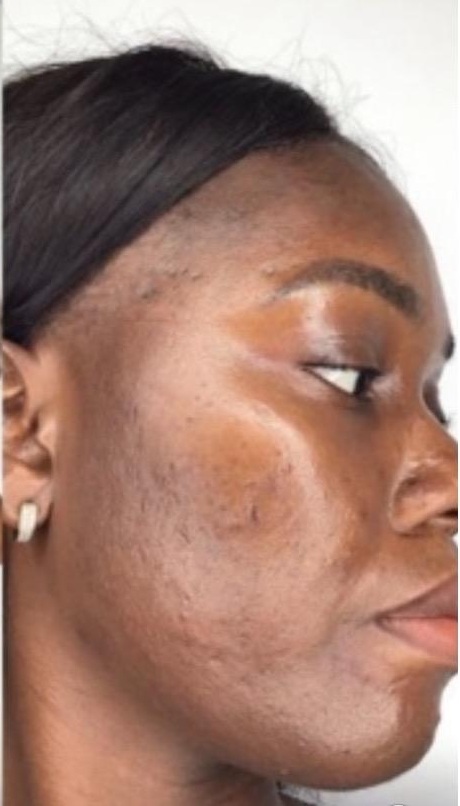 Acne Treatment - Clearer skin with reduced active acne and healthier complexion after treatment.