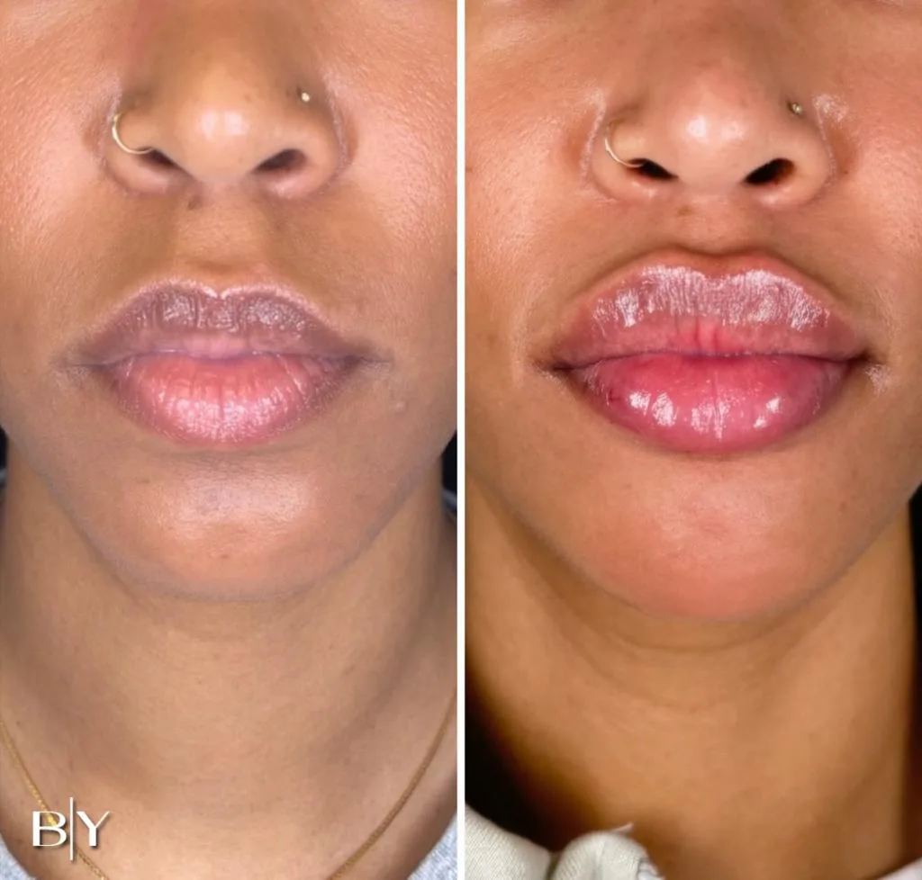 Lip Augmentation